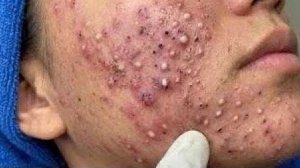 Выдавливание прыщей. НОВОЕ! Угри. Акне. чистка лица.