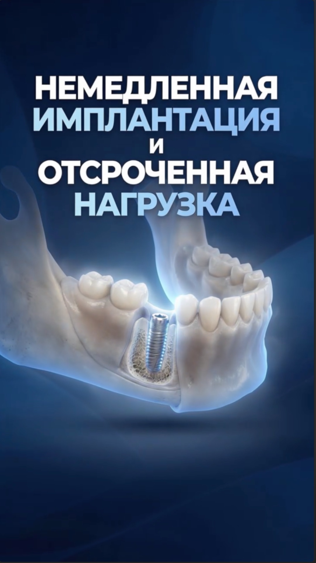 Немедленная имплантация: коронка через 4 месяца. Когда нельзя сразу поставить временный зуб?