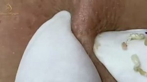 Лечение акне Лоан Нгуен