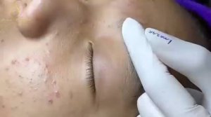Лечение акне от Лоан Нгуен