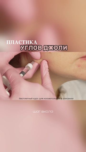 Пластика углов Джоли