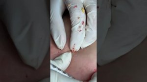 Акне на спине в Hana? И не спрашивай!