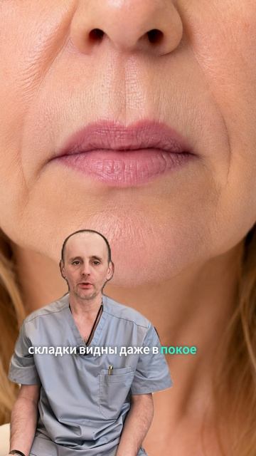 Ботокс или филлер от кисетных морщин  что выбрать?