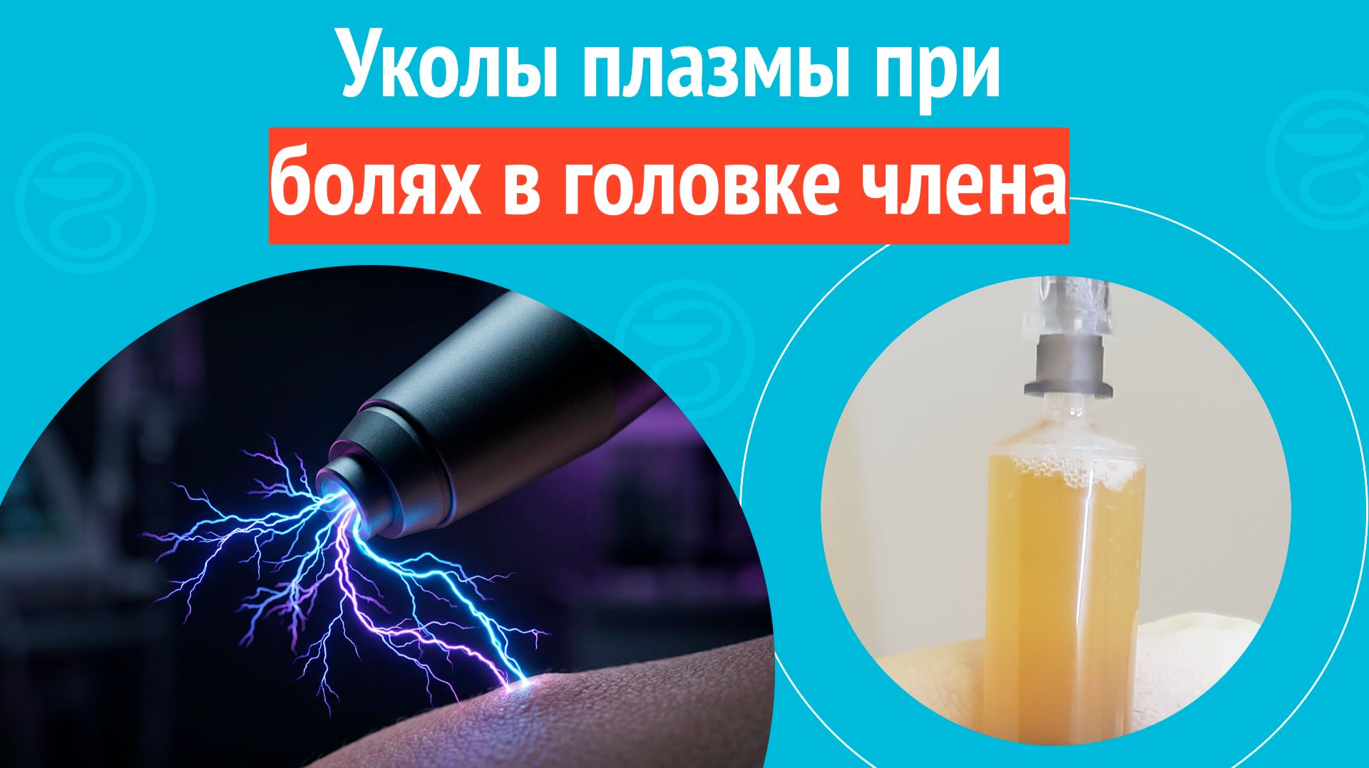 💉 Уколы плазмы при болях в головке члена около уретры. Клинический случай № 1833