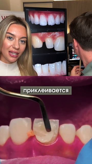 Не спешите ставить виниры