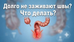 Как убрать дискомфорт в анусе?