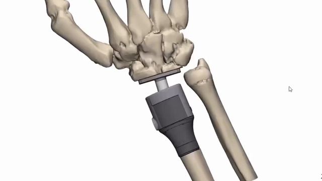 Онкологи Татарстана удалили опухоль руки и установили 3D-имплант пациентке