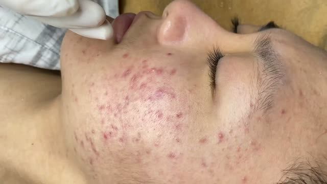 Чистка лица от акне и черных точек