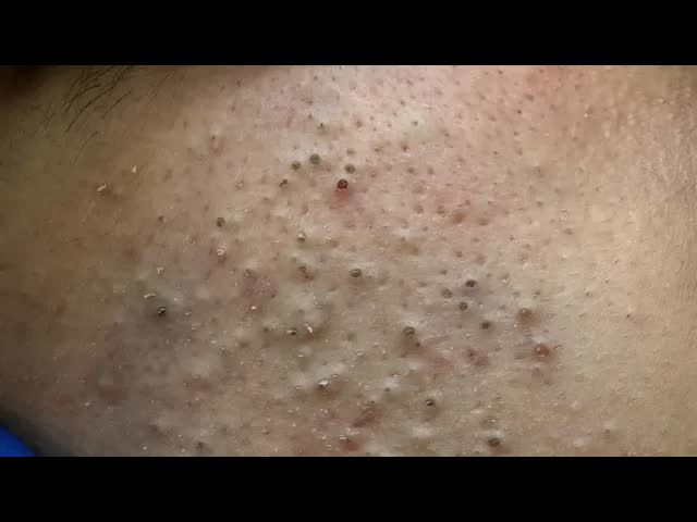 Глубокие чёрные точки! Нежное и эффективное глубокое очищение【Уход за кожей от доктора Лю】