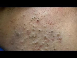 Глубокие чёрные точки! Нежное и эффективное глубокое очищение【Уход за кожей от доктора Лю】