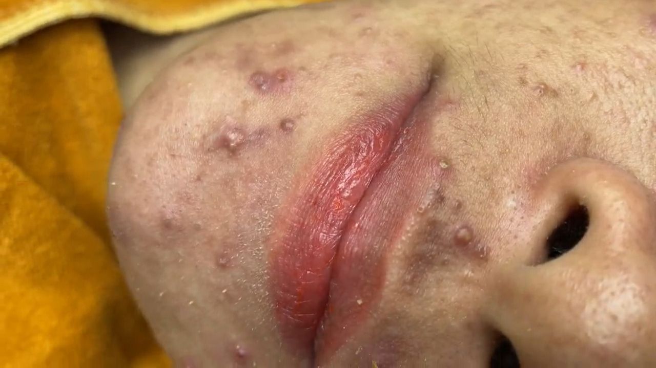 406  Acne collection  АСМР  Relax Spa
