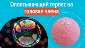 😦 Опоясывающий герпес на головке члена. Клинический случай № 1832