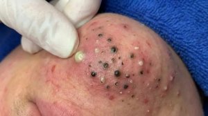 Удаление чёрных точек с Sac Dep Spa