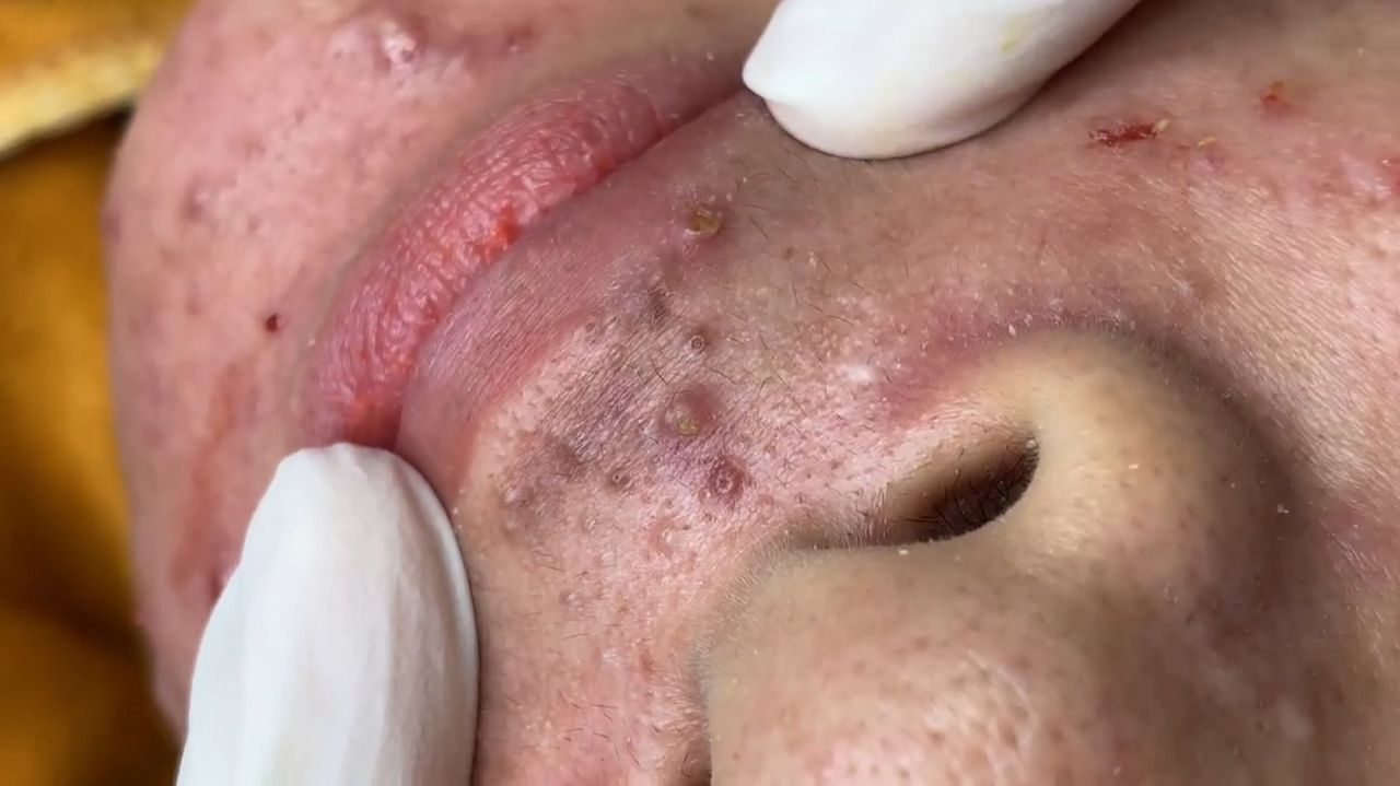 407 • Acne Collection • АСМР • Relax Spa
