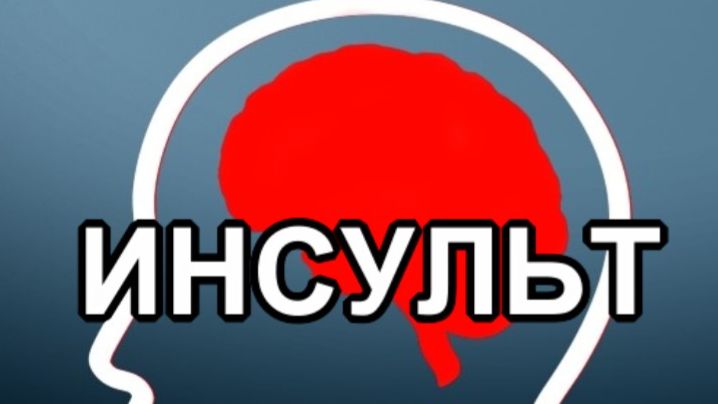 Экспресс восстановление после инсульта