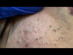 Глубокое удаление черных точек | Лечение прыщей и очищение пор