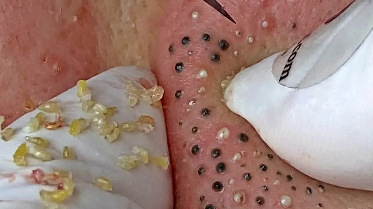 Удаление чёрных точек в спа-салоне Sac Dep