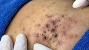 Удаление чёрных точек в спа-салоне Sac Dep