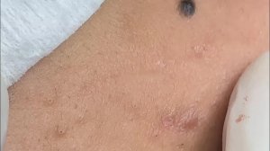 Relaxing Acne Extraction with LinhMyDang Spa #707
