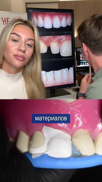 Не ставьте виниры а этом случае, можно обойтись без них.