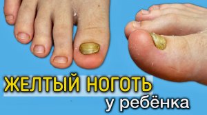 Желтый ноготь у ребенка. Задача родителей регулярно проверять ноги у детей 👀