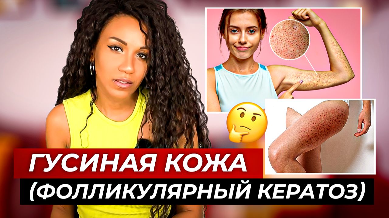 ГУСИНАЯ КОЖА // Фолликулярный кератоз: простые рекомендации как сделать кожу гладкой