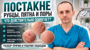 Постакне: рубцы, пятна и поры — что действительно помогает?