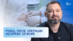 Рубец после операции кесарево сечение
