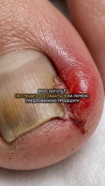 Вросшие ногти :
