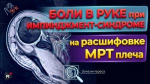 БОЛИ В РУКЕ, субакромиальный ИМПИНДЖМЕНТ СИНДРОМ, АРТРОЗ плеча на РАСШИФРОВКЕ МРТ плечевого сустава