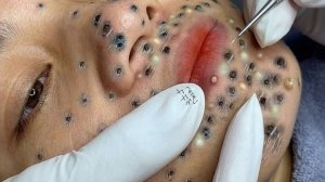 Выдавливание прыщей. «слабонервным не смотреть»