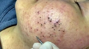 Удаление чёрных точек в SPA-салоне Sac Dep