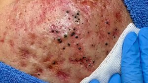 Удаление черных точек в спа-салоне Sac Dep