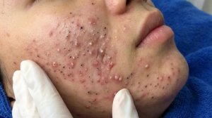 Удаление черных точек с Sac Dep Spa