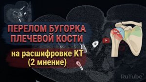 ПЕРЕЛОМ бугорка плечевой кости с формированием КОСТНОЙ МОЗОЛИ после перелома на РАСШИФРОВКЕ КТ плеча