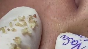ВЫДАВЛИВАЕТ ПРЫЩИ И УГРИ. СОЧНОЕ РЕЛАКС ВИДЕО