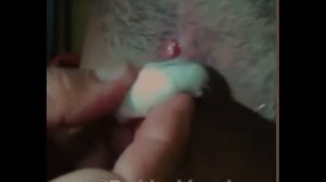 Выдавливание прыщей и гнойников  ЖЕСТЬ