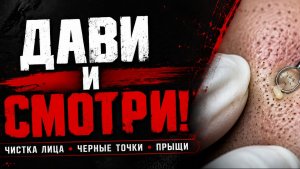 Глубокое очищение пор от черных точек | Преображение кожи