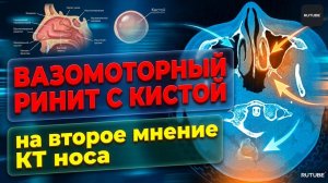 КИСТА в левой пазухе носа и ВАЗОМОТОРНЫЙ РИНИТ на расшифровке КТ пазух носа (ВТОРОЕ МНЕНИЕ КТ)