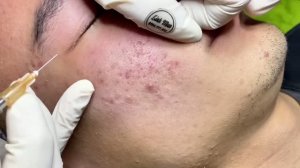 Чистка кожи от акне – профессиональный уход