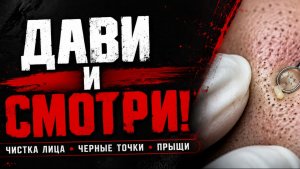 Выдавливание прыщей за неделю #72