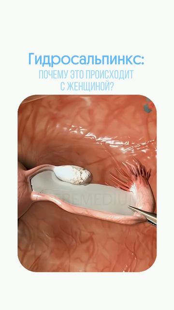 Гидросальпинкс — состояние, когда маточная труба закрывается и заполняется жидкостью