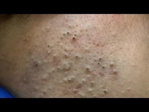 Глубокое очищение пор | Удаление черных точек и прыщей