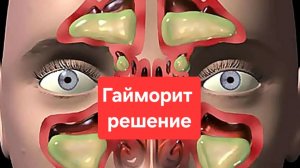 Гайморит.Причины.Что делать.