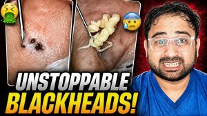 Неостановимое удаление чёрных точек — много накоплений | Чистка 😱 [Часть 18]
