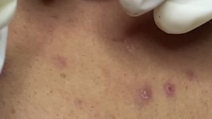 #887 Удаление акне. Экстракция комедонов. Подкожные прыщи. Чистка от черных точек