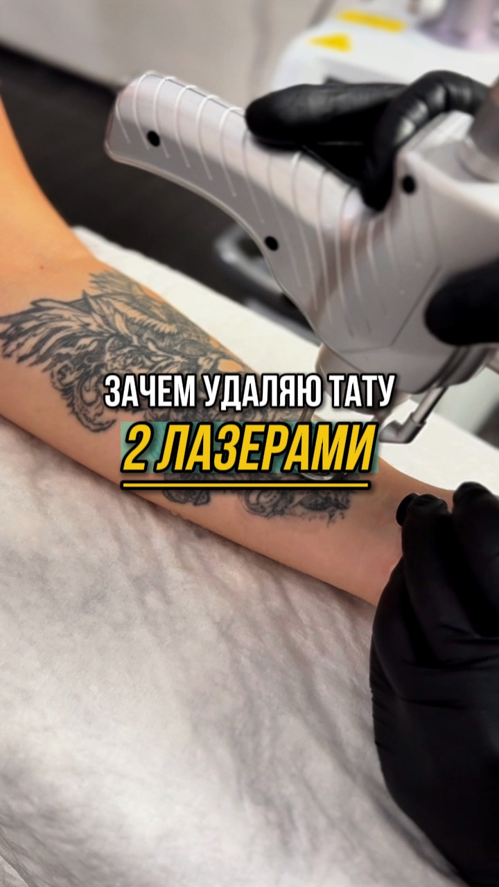 ЗАЧЕМ Я УДАЛЯЮ ДВЫМЯ ЛАЗЕРАМИ?