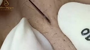 Удаление чёрных точек в спа-салоне Sac Dep