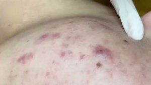 Удаление акне и комедонов – быстро и аккуратно