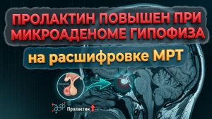 ПОВЫШЕННЫЙ ПРОЛАКТИН у мужчин при МИКРОАДЕНОМЕ ГИПОФИЗА на МРТ расшифровке (второе мнение МРТ)